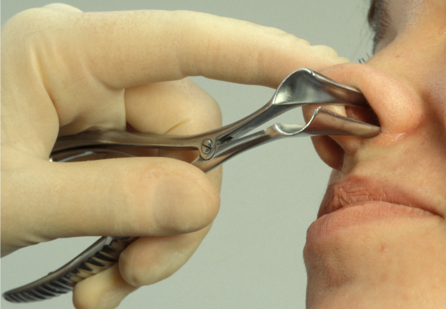 تشخيص الرعاف